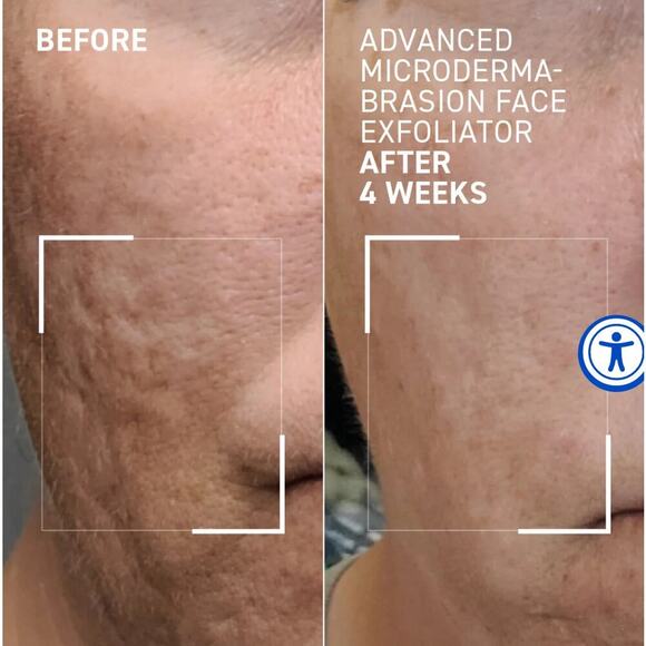 Dr. Brandt microdermabrasion
ADVANCED FACE EXFOLIATOR - Picture 3 of 7